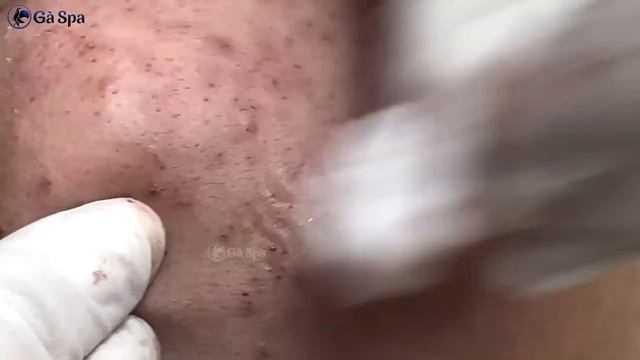 Relaxing Acne Treatment |Acnes Treatment   1 #005