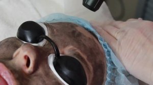 Урок. Лазерный карбоновый пилинг