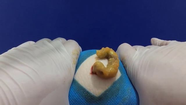 BEST Pimple Popping // Big Cystic Acne Blackheads // Whiteheads Removal / Squeezing Pimples / He#06 смотреть онлайн