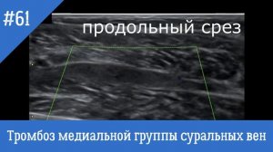 УЗИ сосудов (Видиофрагменты 61, 62). Тромбоз медиальной группы суральных вен.