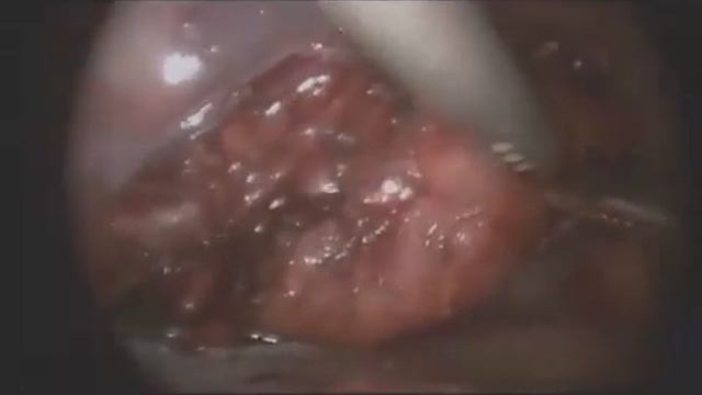 Ганглионеврома.mp4