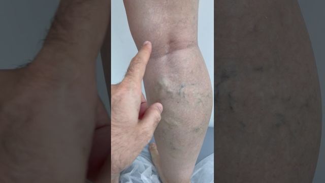 Нетипичная форма варикоза. Как лечить варикоз? Флеболог Москва. Флеболог. Сосудистый хирург смотреть онлайн