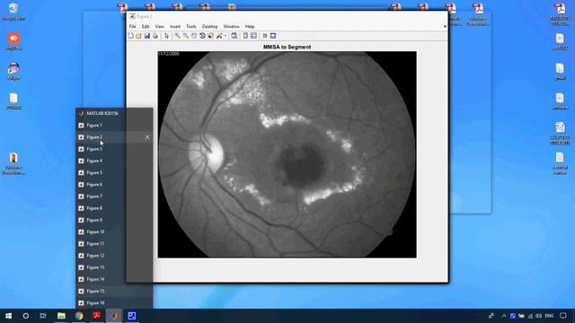 Exudates Detection Using Morphology Mean Shift Algorithm in Retinal Images in Matlab смотреть онлайн