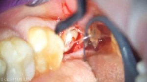 Удаление зуба мудрости , удаление восьмёрки , удаление 48 зуба , быстрое удаление зуба