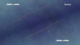 Roche In Spinal Muscular Atrophy  Making A Difference For Families