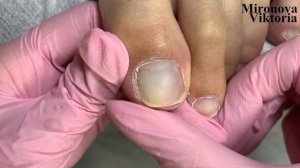 Как правильно стричь ногти на ногах?