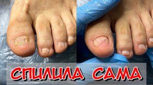 Грибок / Подтвержденный грибок / Микоз / Что делать дальше Повторный визит / Педикюр