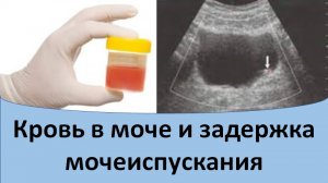 Кровь в моче у мужчин.