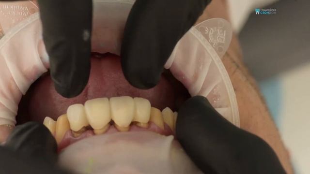 СТОМАТОЛОГИЯ «СТОМДОМ» | Установка виниров и коронок смотреть онлайн