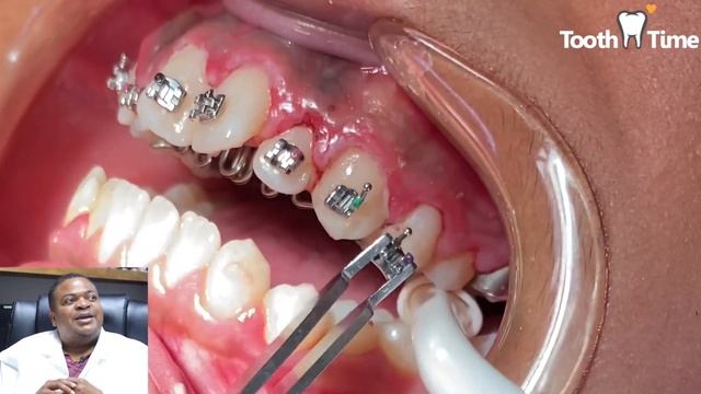 Dental Braces: Tongue Crib + RPE - Tooth Time New Braunfels Texas Orthodontics смотреть онлайн