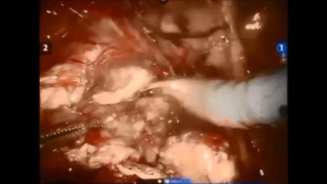 Robotic Left RPLND (Retroperitoneal Lymph Node Dissection) / Modified Template - Kurt Strom MD смотреть онлайн