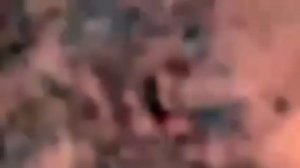 Это просто Жесть!! Огромные Угри  на лице!!