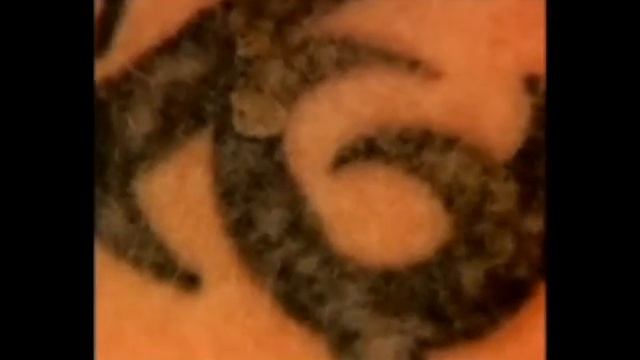 Удаление татуировки неодимовым лазером смотреть онлайн