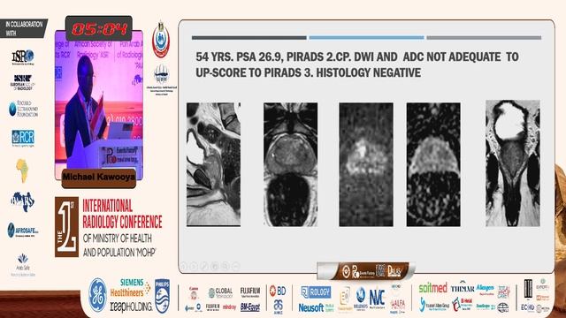 Challenges With MRI Screening for Prostate Cancer Using Pirads V2.1 In An African Population смотреть онлайн
