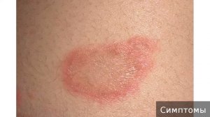 Лишай  Как лечить лишай