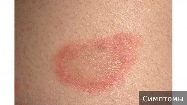 Лишай Как лечить лишай