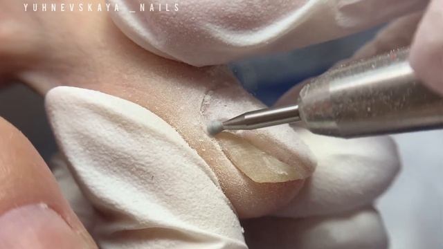 Большая зачистка онихолизиса/последствия ношения не правильной обуви #подология #онихолизис #подоло смотреть онлайн