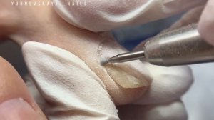 Большая зачистка онихолизиса/последствия ношения не правильной обуви #подология #онихолизис #подоло