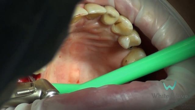 Можно ли ставить имплант сразу после удаления зуба? Одномоментная имплантация за 9 минут