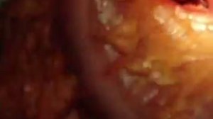 толстокишечная непроходимость 0001