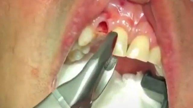 удаление передних зубов смотреть онлайн