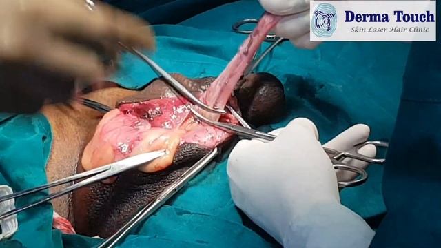 Orchidectomy अंडकोश निकालना смотреть онлайн