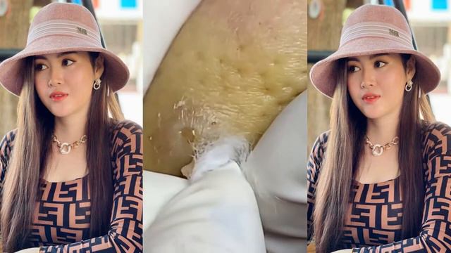 Best Bleckheads,Blackheads Removal,Blackhead Extractions, Выдавливание черных точек прыщей 2022