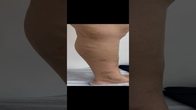 Нетипичная форма варикозной болезни. Флеболог Москва смотреть онлайн