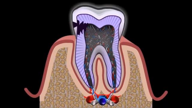 Что такре пульпит  Воспаление зуба  Как лечить пульпит  Стоматология