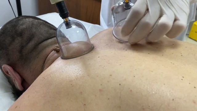 Хиджама - лучшее лечение смотреть онлайн