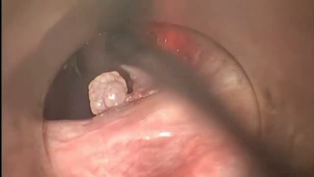 Удаление папиллом гортани при помощи СО2 лазера смотреть онлайн