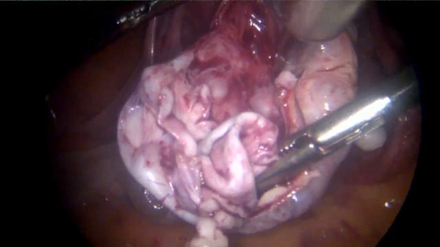 Многокамерная киста яичника. Цистаденома яичника? смотреть онлайн