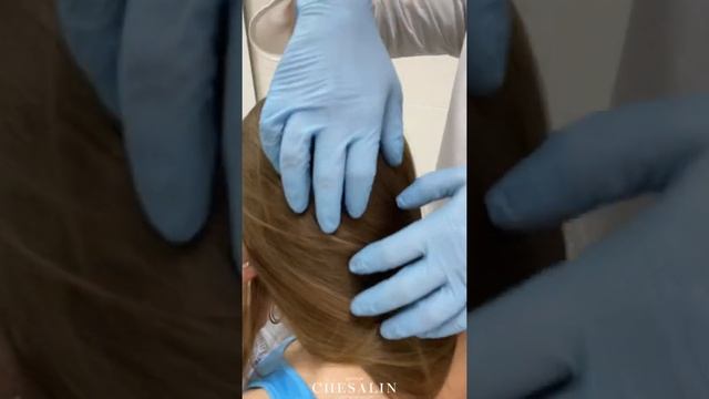 6 дней с момента пересадки бровей. Как выглядят брови после пересадки. Трансплантация бровей смотреть онлайн