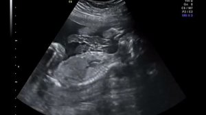 УЗИ плода с определением пола