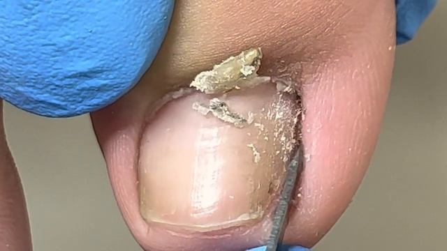 Triangular Ingrown Nails... Let The Patient Relax For A Pedicure【Xue Yidao】