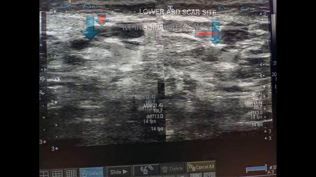 Post-operative Subcutaneous Seroma + Inguinal Lymphadenopathy смотреть онлайн
