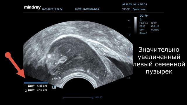 УЗИ в урологии. Опухоль семенного пузырька смотреть онлайн