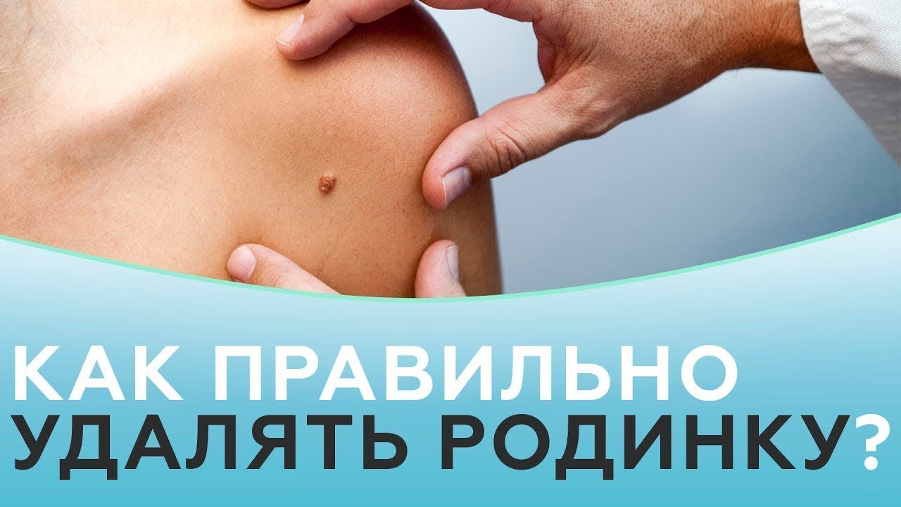 Родинки. Методы удаления родинок. смотреть онлайн