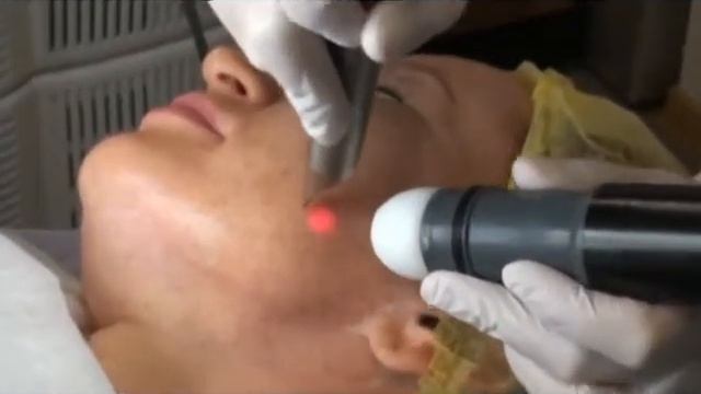 Лазерное смус-омоложение кожи смотреть онлайн