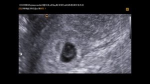 5-6 недель беременности  на УЗИ - несостоявшаяся двойня