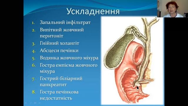 Лекція "Гострий холецистит та його ускладнення", професор Н.І. Бойко смотреть онлайн
