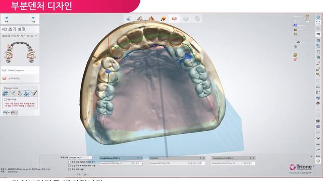 DIO Dental System 21 ver 부분덴처 디자인 pptx смотреть онлайн