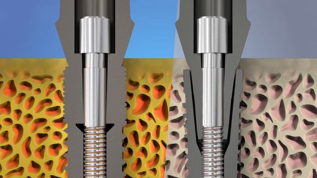 Имплантаты ИРИС ( IRIS ) : что Вам нужно знать об особенностях имплантов ИРИС.