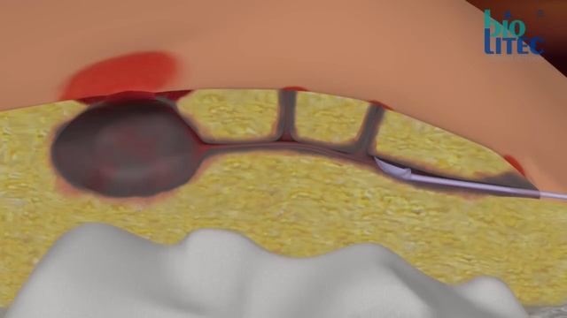 SiLaC® For Sinus Pilonidalis By Biolitec®