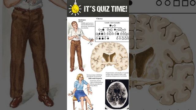 What is the inheritance pattern of Huntington's disease? смотреть онлайн