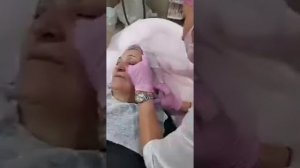 Коррекция височной зоны филлерами