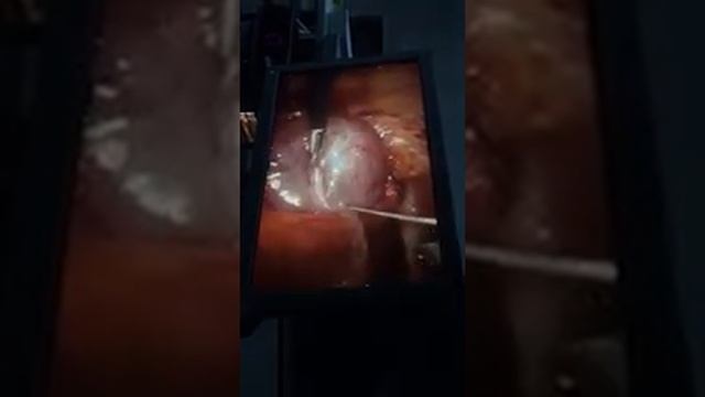 Laparoscopic renal cyst decortication смотреть онлайн