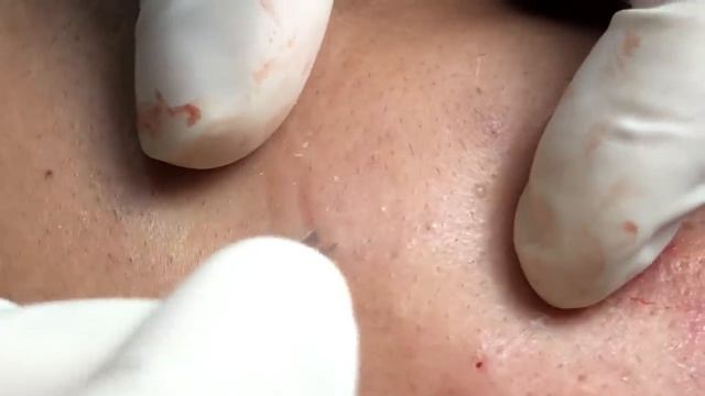Acne beneath the skin смотреть онлайн