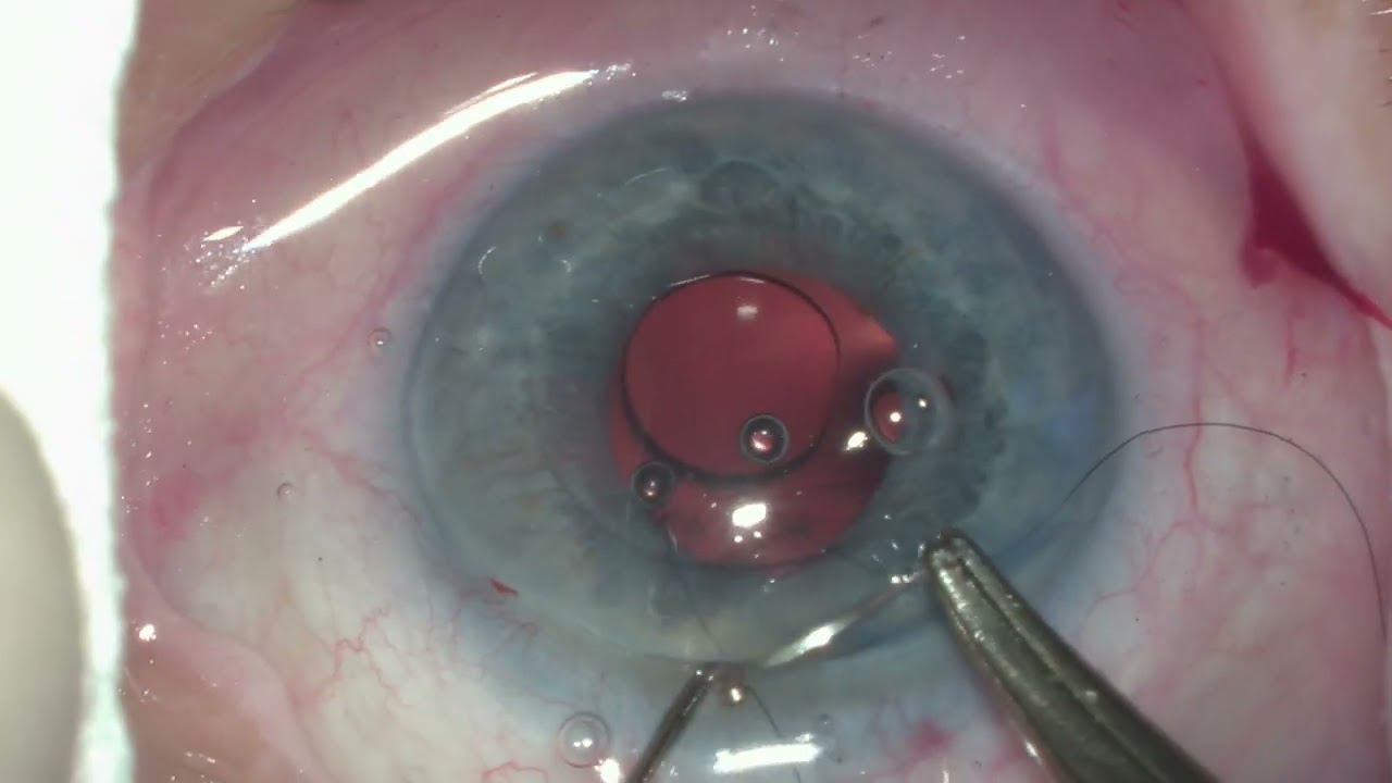 Интракапсулярная экстракция катаракты