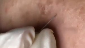 Механическая чистка лица от чёрных точек